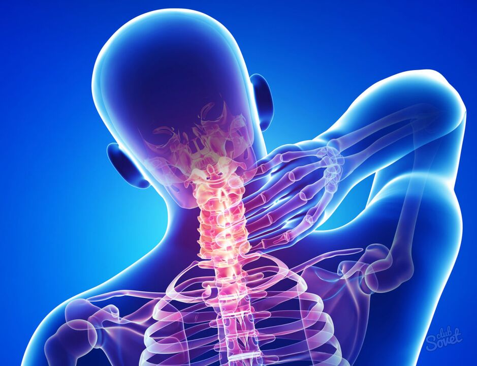 osteocondrosis cervical