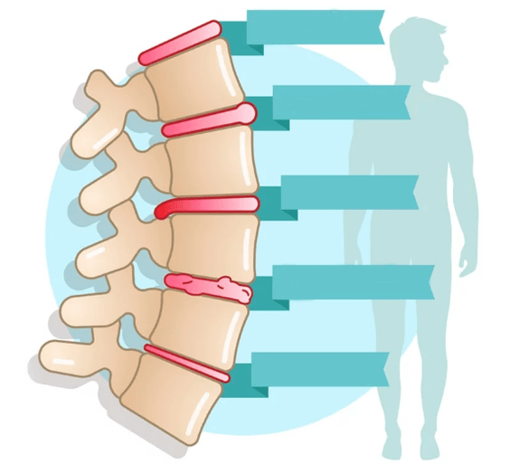 Grado de enfermedad de la osteocondrosis torácica