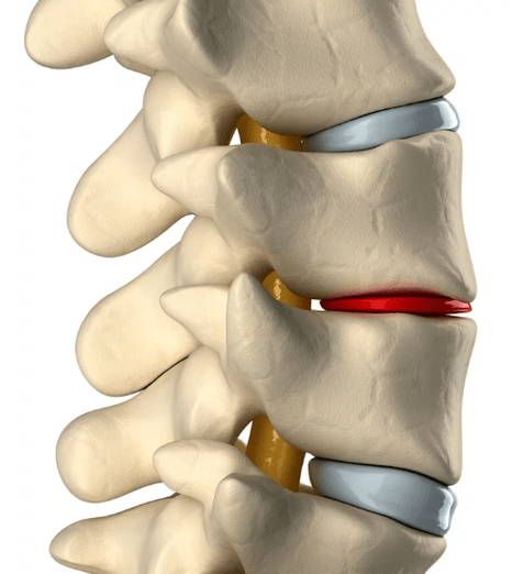 osteocondrosis de la columna torácica