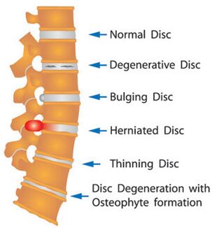 Varios daños al disco de la columna