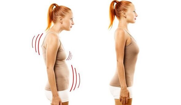 espalda recta y mala postura con osteocondrosis cervical