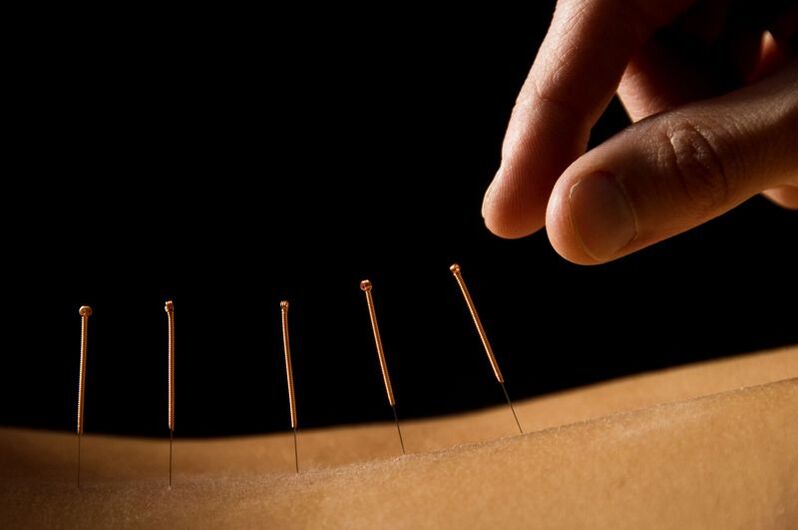 acupuntura para el dolor lumbar