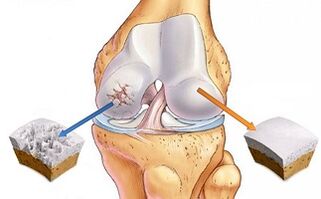 cartílago sano y artrosis de la articulación de la rodilla